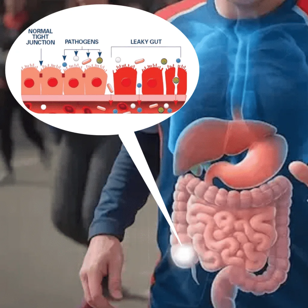 Illustration of normal and leaky gut lining, with gaps letting pathogens through